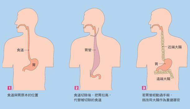 食道癌手术后疼痛怎么办