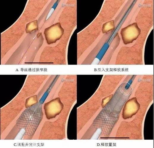 食道癌晚期放疗效果如何