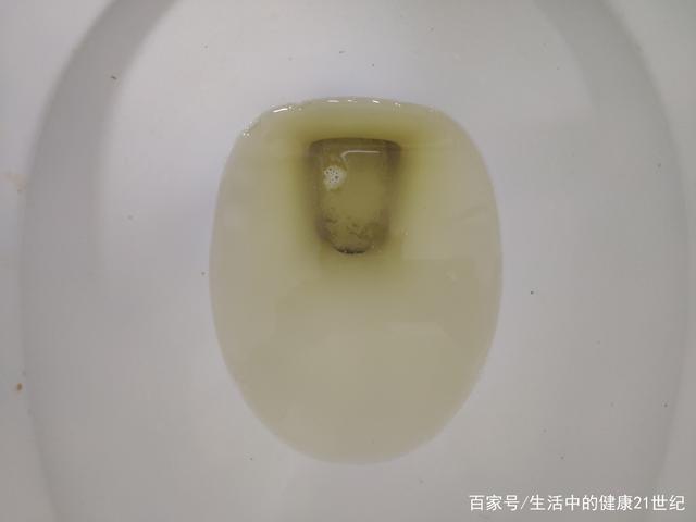 得尿毒症排便正常吗