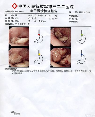 胃镜能立刻查出食道癌吗