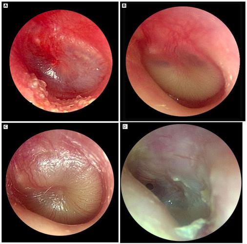 耳垂流脓是中耳炎吗