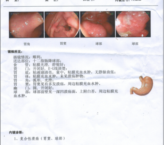 多发性胃溃疡需要治疗吗