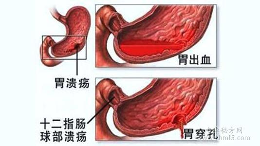 多发性胃溃疡需要治疗吗