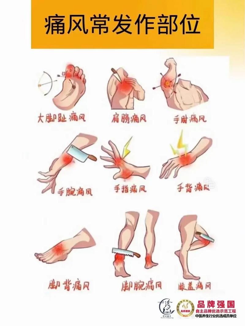 痛风是一个怎么样的疾病