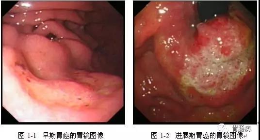 多发性胃溃疡需要治疗吗