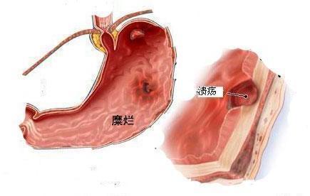 多发性胃溃疡能吃桃子吗