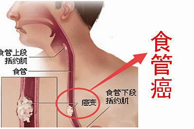 是不是食道癌术后有转移