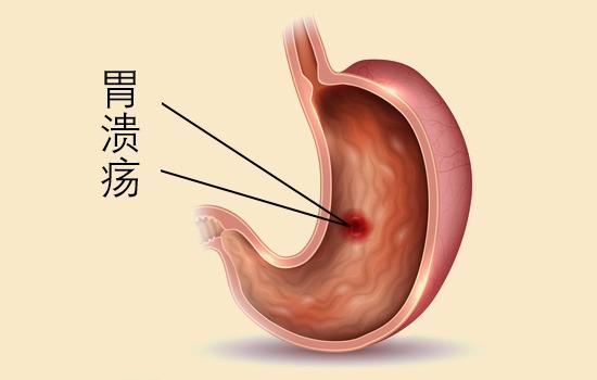 多发性胃溃疡能吃桃子吗