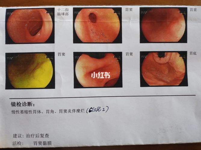 二十七八岁会得胃溃疡吗