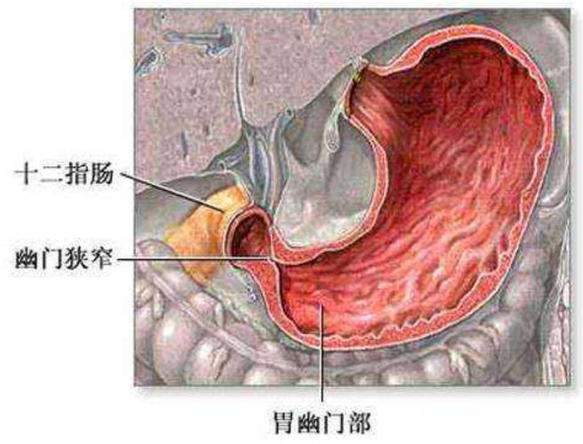 恶性胃溃疡是怎样形成的