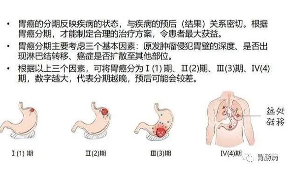 胃癌中期怎样治疗好一点