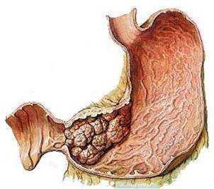 胃癌中期怎样治疗好一点
