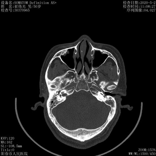 耳朵出血ct显示中耳炎