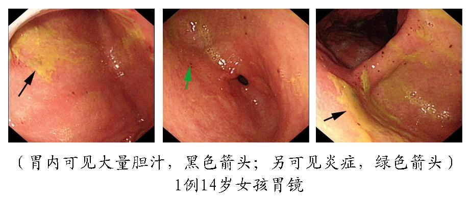 中度慢性胃炎活动性2+