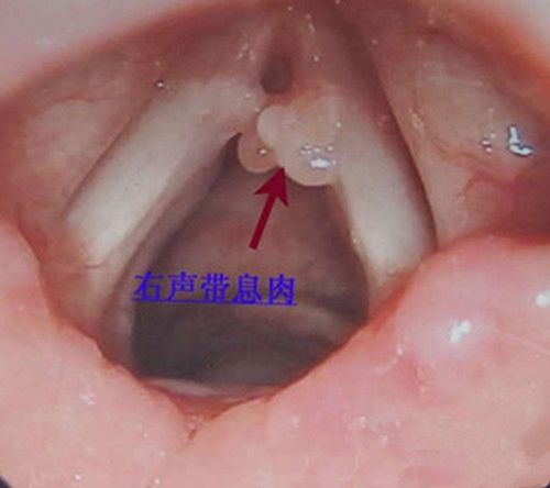 声带息肉影响发音吗