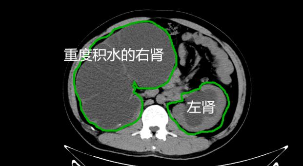 左肾积水是什么意思