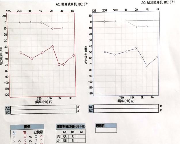 耳鸣一般做哪些检查项目