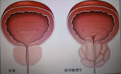 尿潴留肾积水的症状