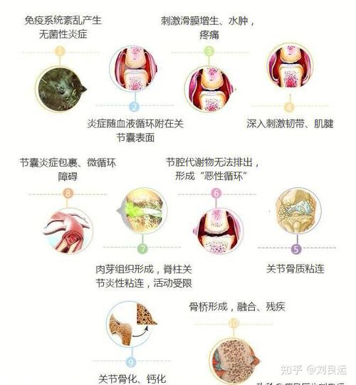 强直性脊柱炎的发病原因