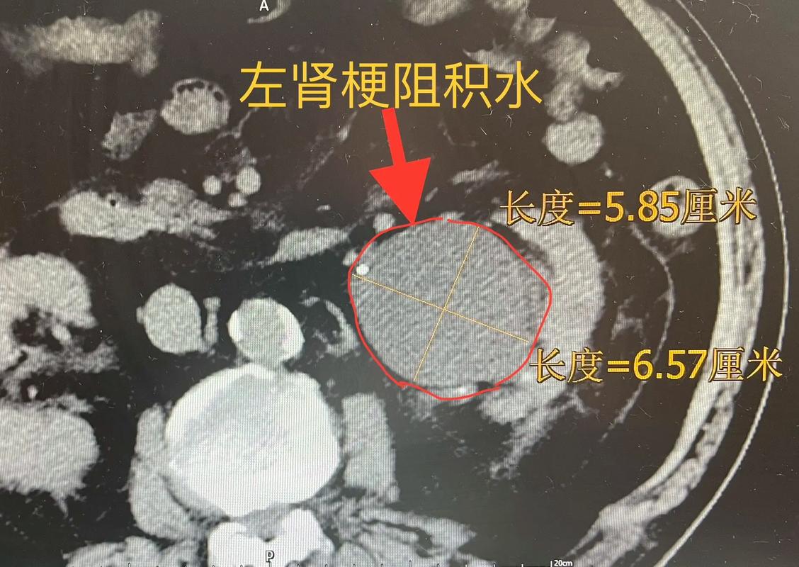 十几岁肾积水怎么办