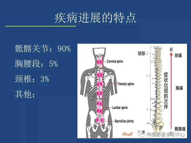 强直性脊柱炎的发病原因