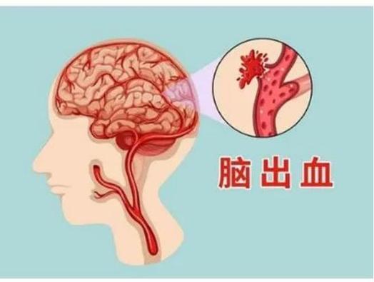 怎么判断白血病脑出血