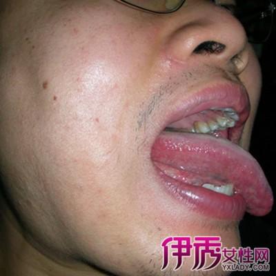 白血病舌头有什么症状