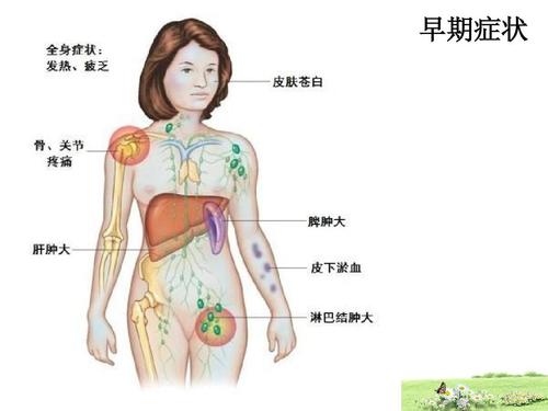 怎么样的人容易白血病