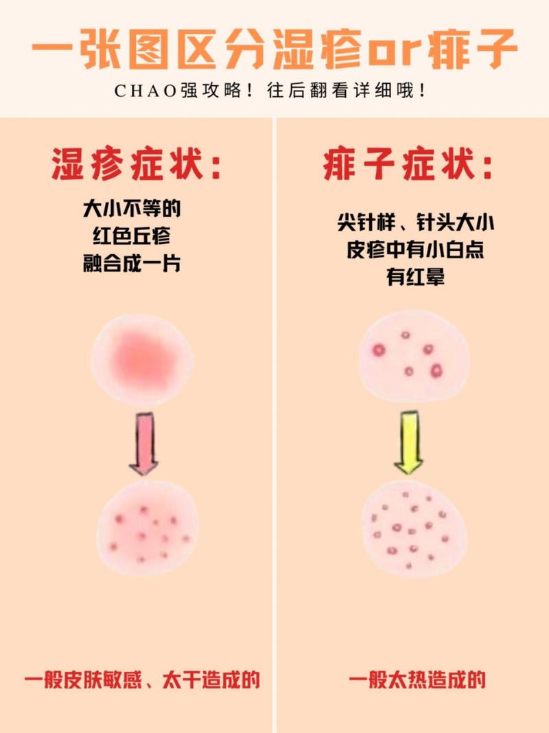 过敏和湿疹怎么区别