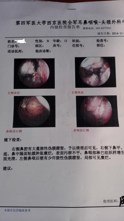 什么是鼻窦恶性淋巴瘤