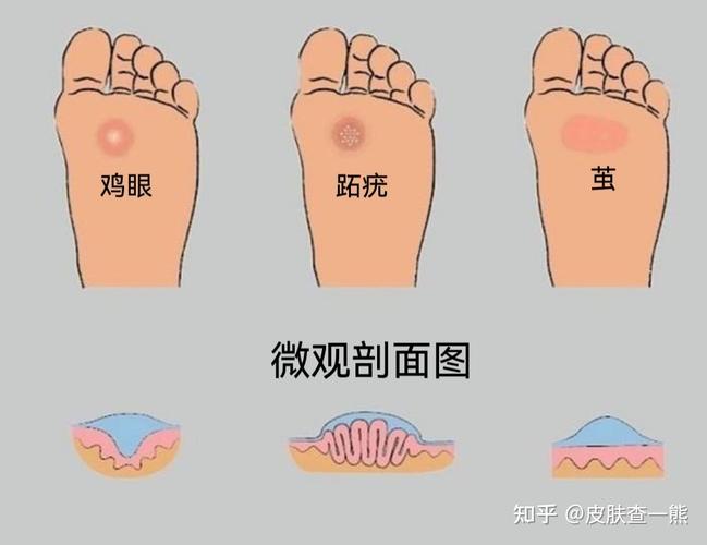 血刺泡是不是脚鸡眼