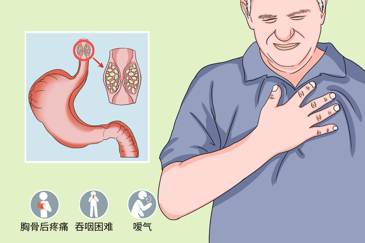 食道癌会咳嗽有痰吗