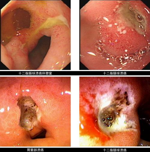 十二指肠溃疡的影响