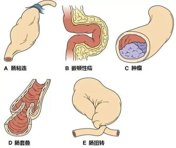 肠梗阻便血是什么症状