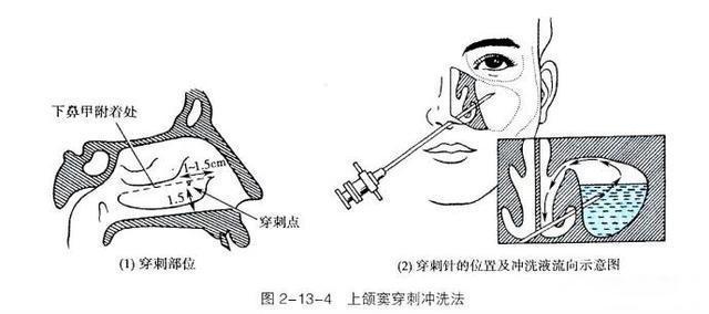 鼻窦炎穿刺手术疼吗