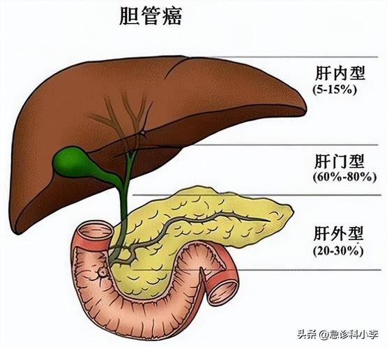 胆管癌扩散的表现症状