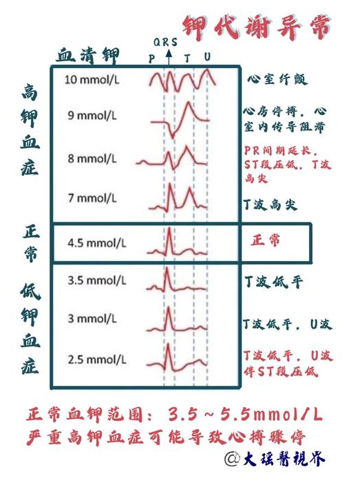 低钾血症如何诱发心衰