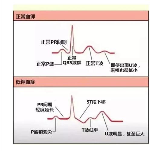 低钾血症如何诱发心衰