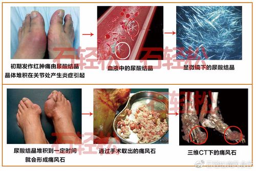 痛风有没有不疼的