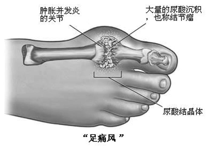 脚趾关节痛是痛风吗