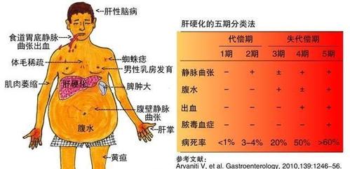 肝硬化晚期会很痛苦吗