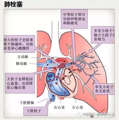 急性肺栓塞是怎么回事