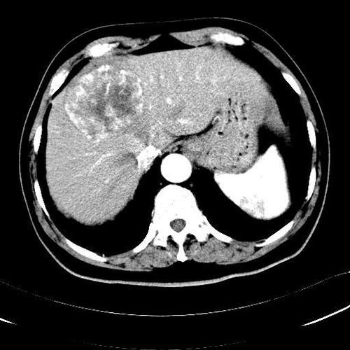 增强ct能查出肝癌吗