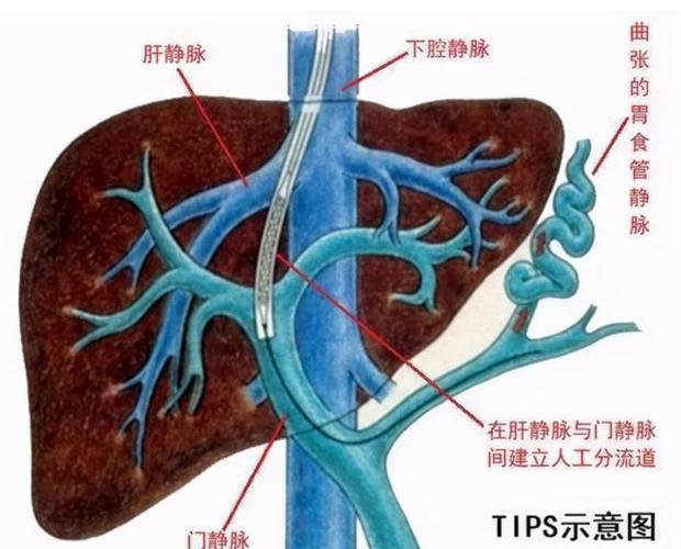 肝硬化介入治疗是什么