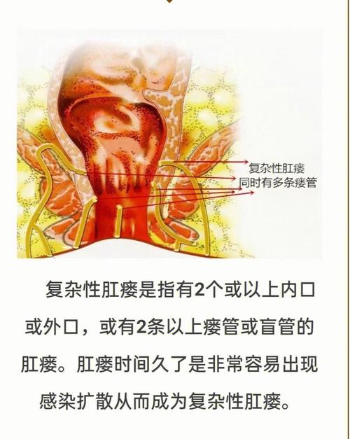 肛瘘是不是很容易复发