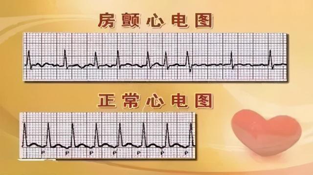 贫血心跳会导致房颤吗