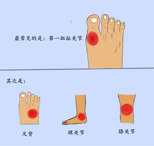 脚背痛是不是痛风