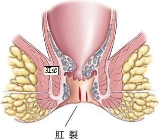 肛裂口子不愈合怎么办