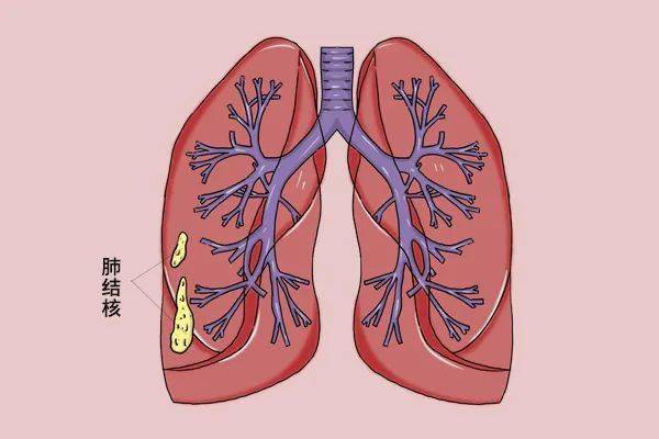 肺结核发烧不退怎么办