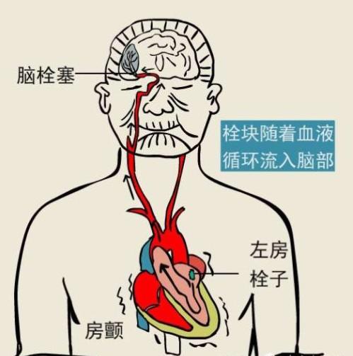 神经衰弱会引发房颤吗